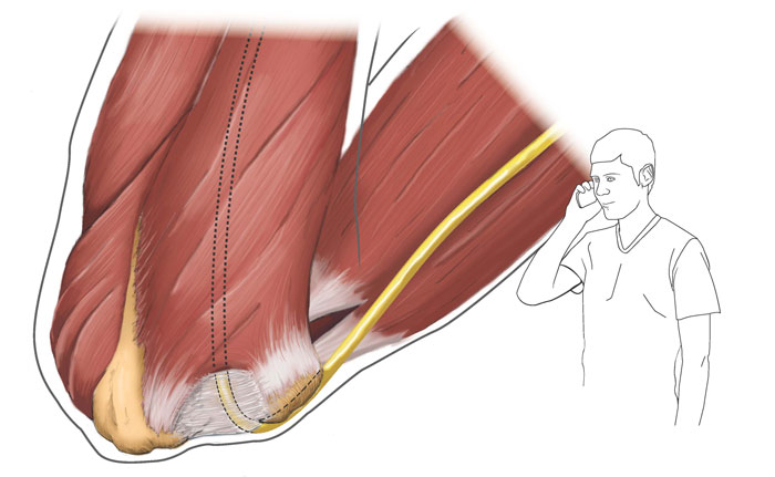 درد آرنج / cell phone elbow